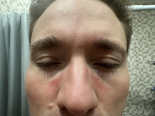 Rote Streifen um die Nase Rote Streifen um die Nase